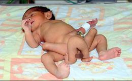 ملتان: چار ہاتھ پیروں والے بچے کی پیدائش