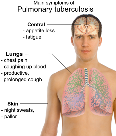 Tuberculosis ٹی بی