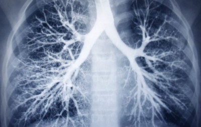 Lungs xray