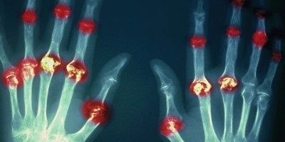 rheumatoid arthritis, hand x-rays