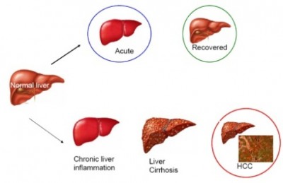 Liver Infection 