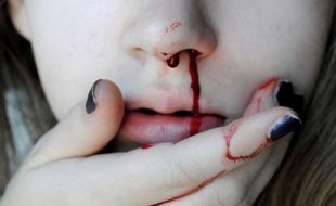 ناک سے خون بہنا زیادہ خطرناک بھی ہو سکتا ہے