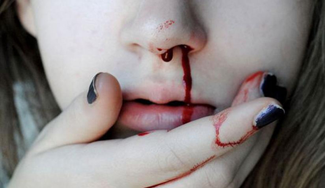 ناک سے خون بہنا زیادہ خطرناک بھی ہو سکتا ہے