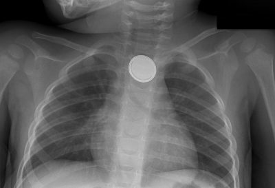 Xray_of Button Battery Lodged in Childs Throat