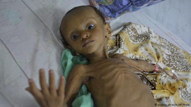 یمنی جنگ: نصف سے زائد آبادی کو خوراک کی شدید قلت کا سامنا