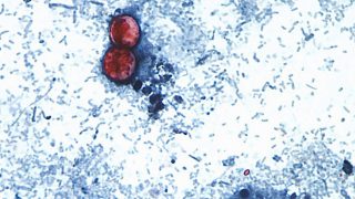 FDA Closes Investigation into "Explosive Diarrhea" Outbreak, Traces Parasite to Mexican Lettuce Operations