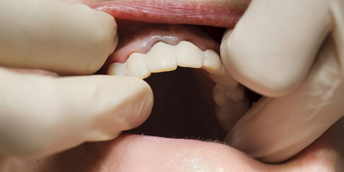 French Dental Labs Sound Alarm as Chinese Prosthetics Flood Market