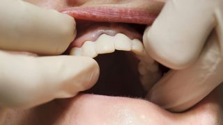 French Dental Labs Sound Alarm as Chinese Prosthetics Flood Market